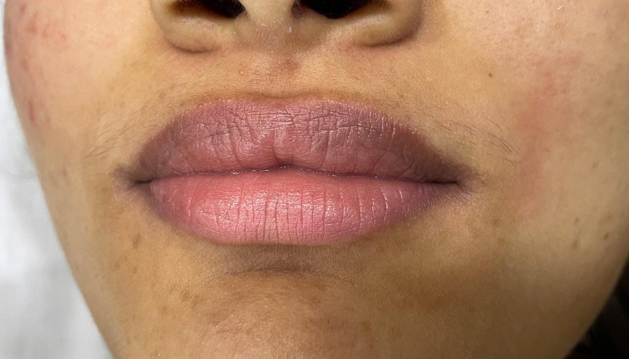 Before - Under Eye Hollowness Filling